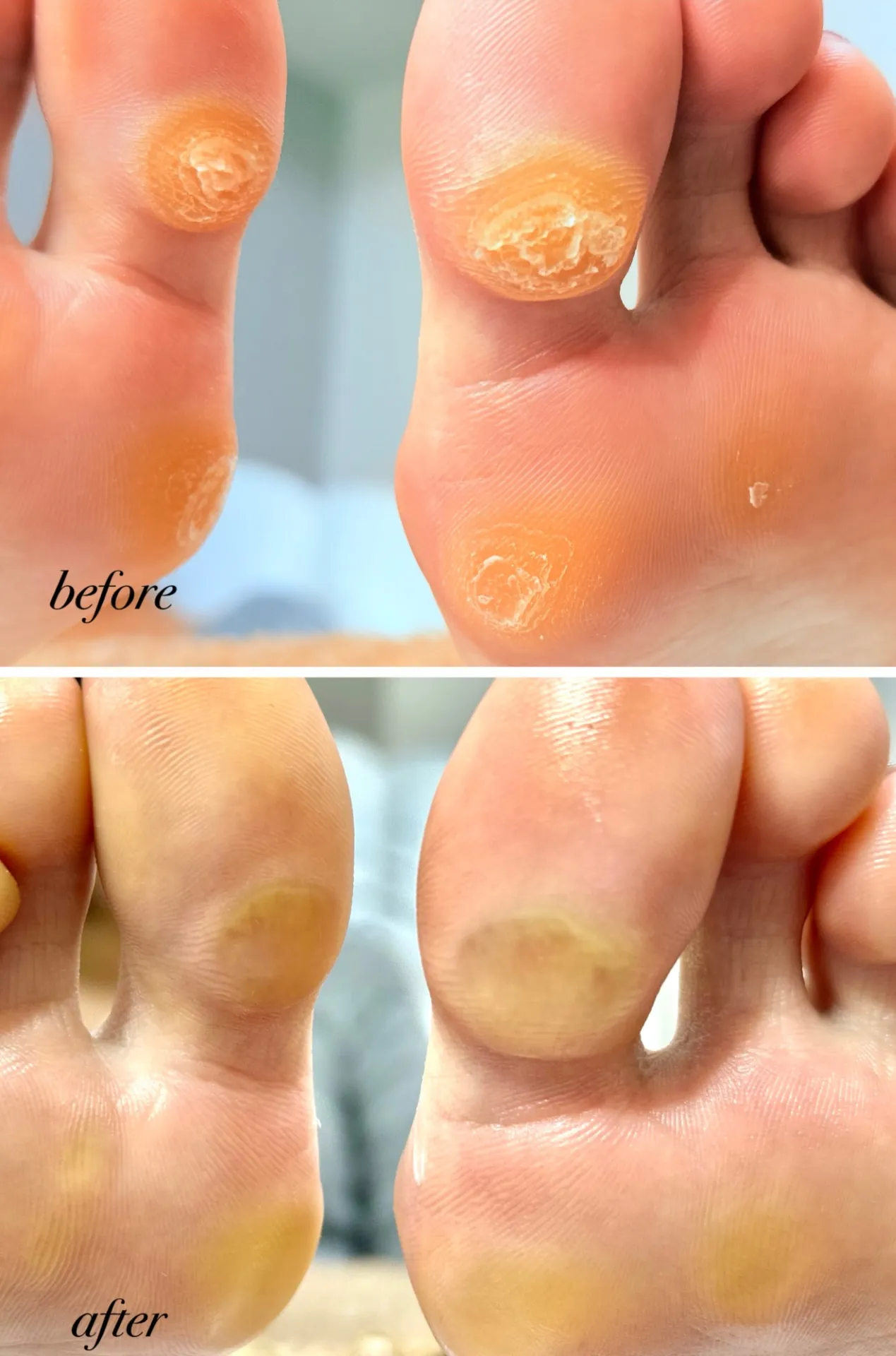  親指にタコガチガチ