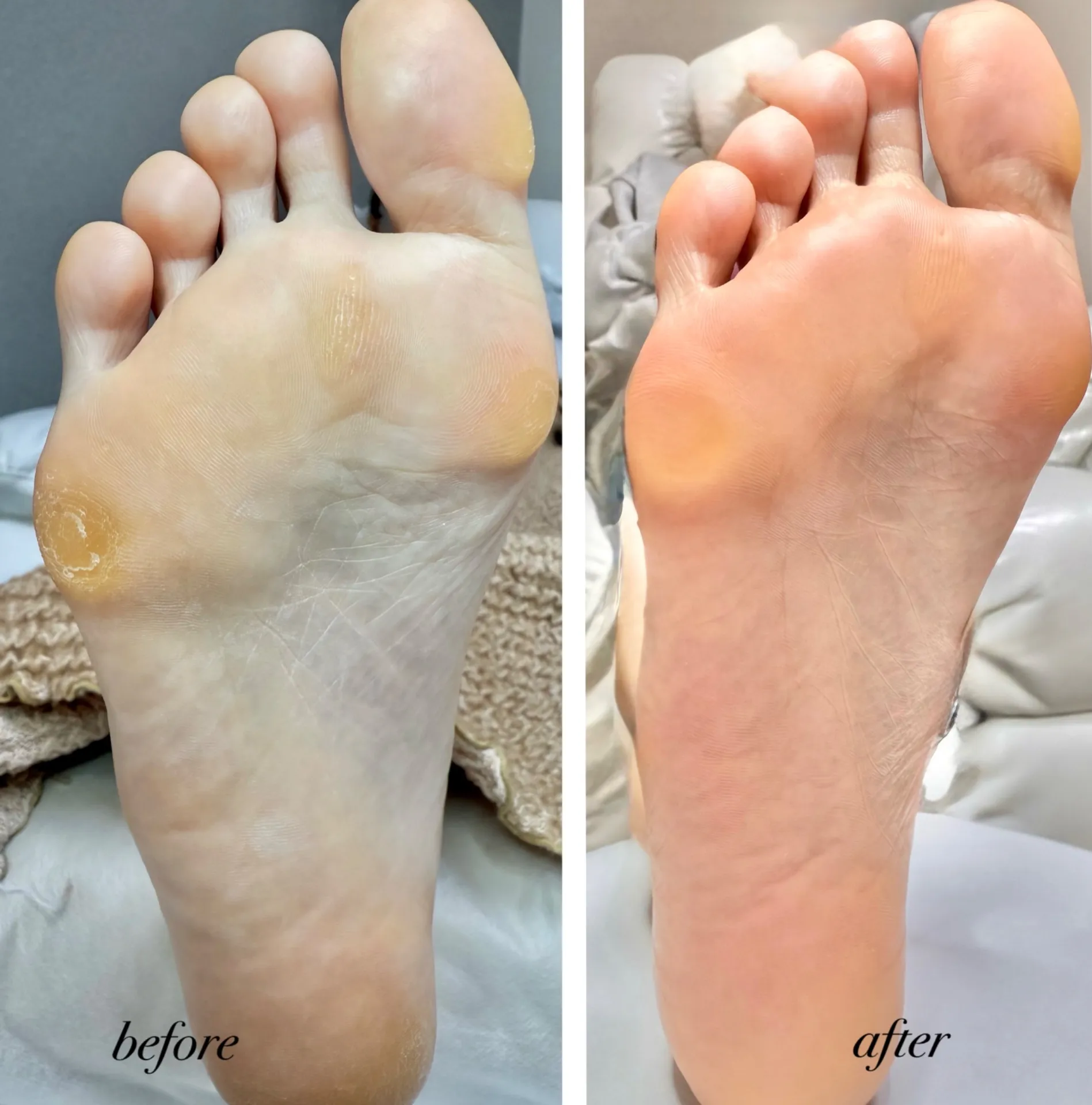 タコで歩きにくい