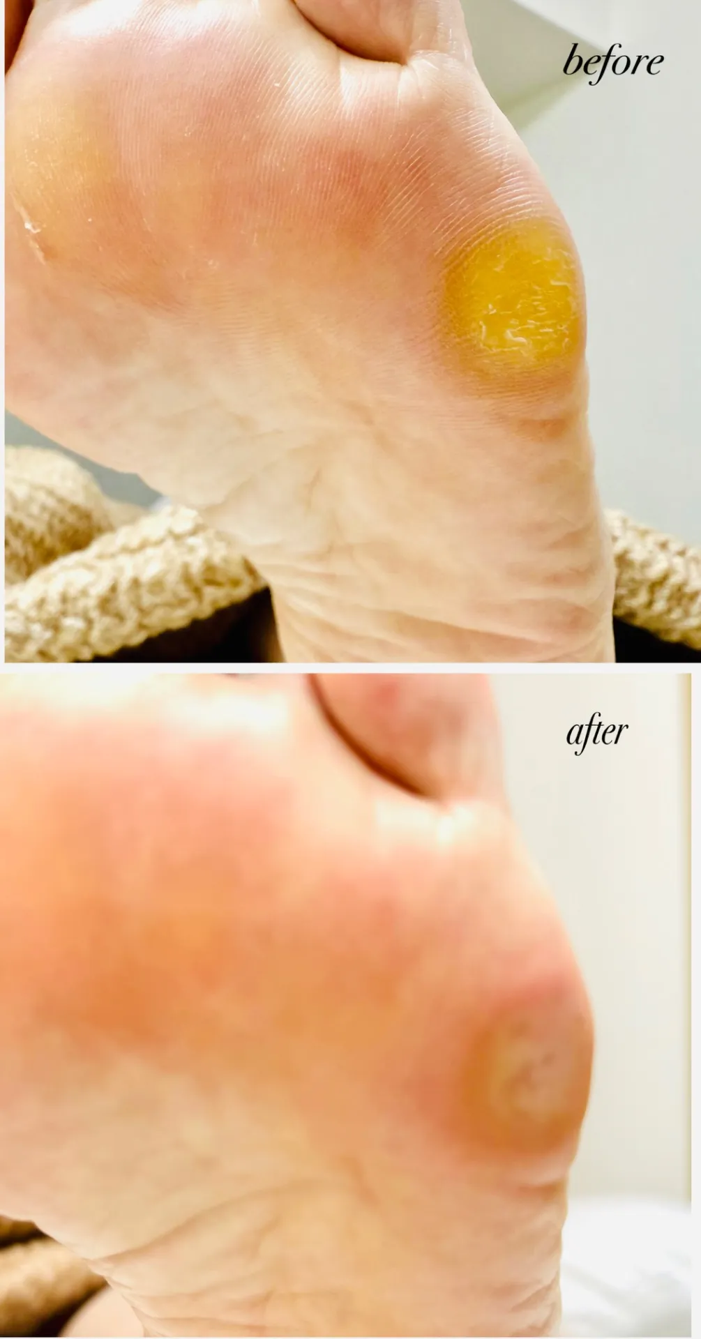 ガチガチに硬いタコができて歩くのが辛い