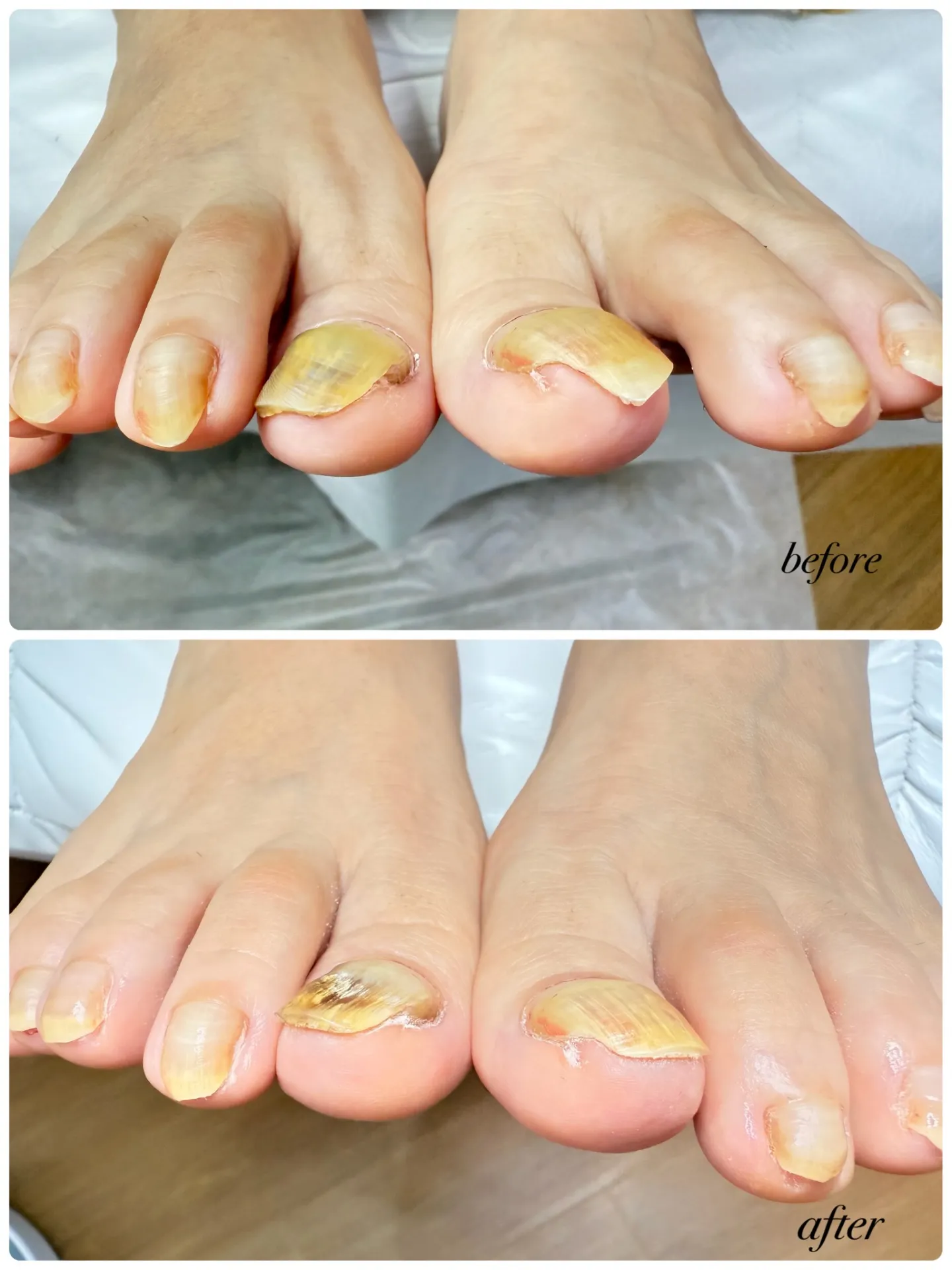 巻き爪どうやって切るの？