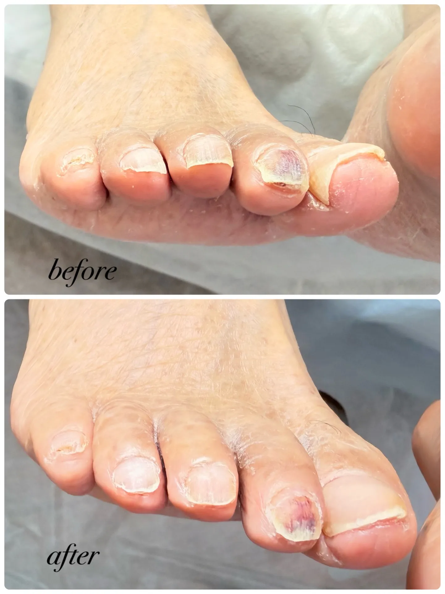 冬になると毎年かかと痛くて、爪もどうしていいのか