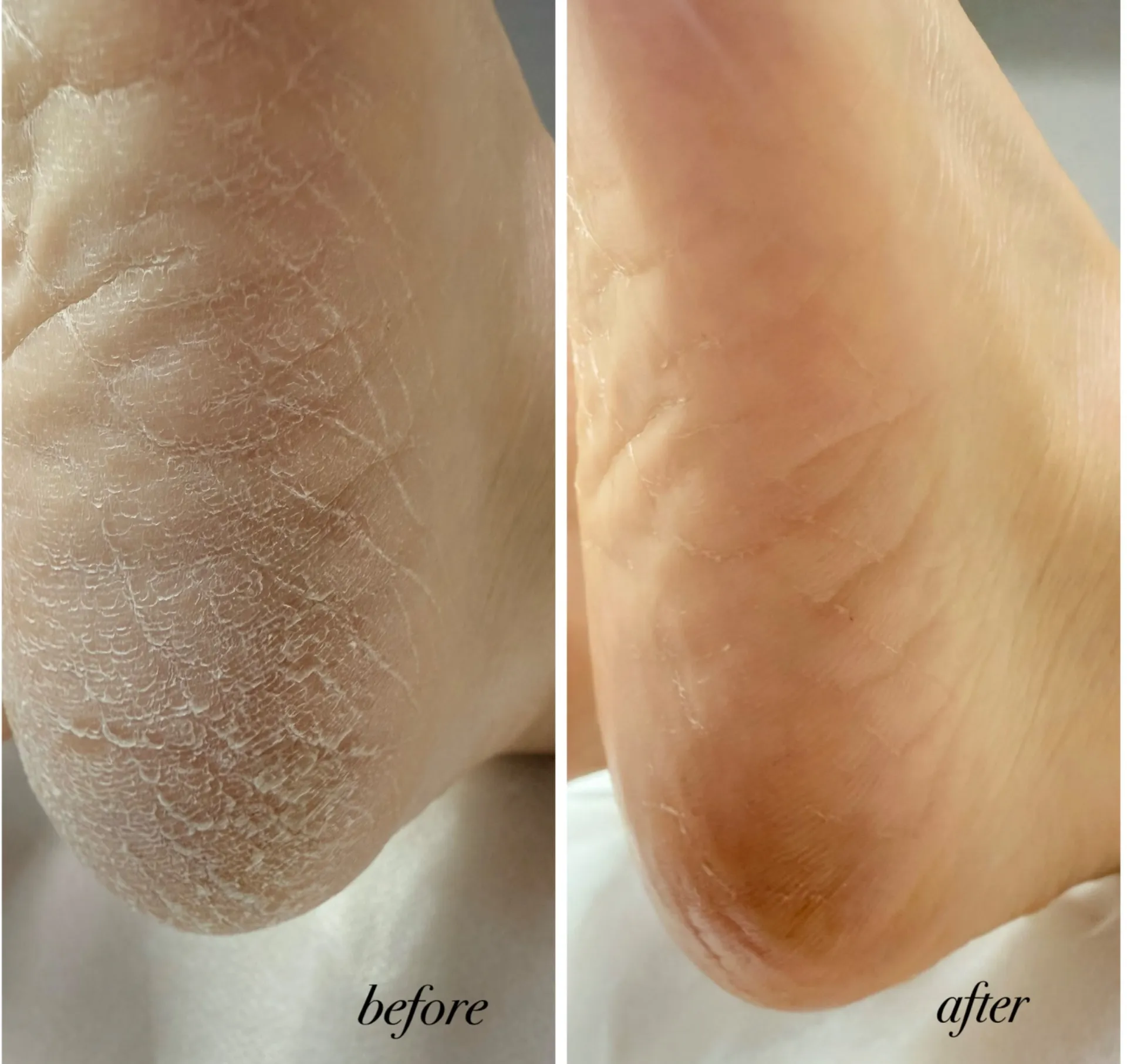 かかとガサガサで寝ていても