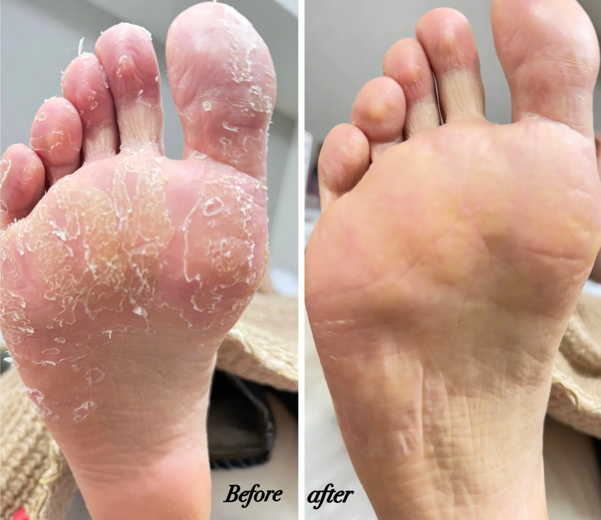 履くだけで角質ケアが残念な結果に